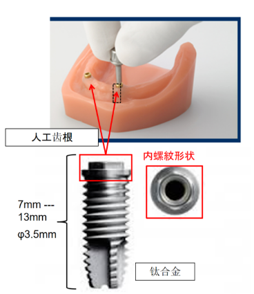 種植牙內(nèi)螺紋銑削.png